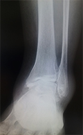 変形性足関節症の単純レントゲン写真